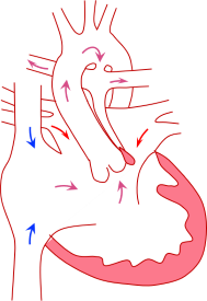 中央が右室型単心室