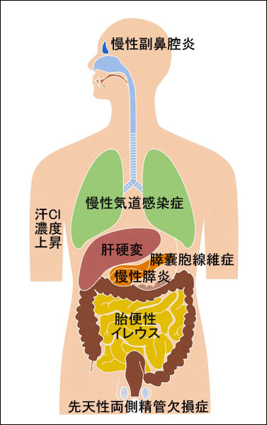 図はCFTR遺伝子の変異を原因とするCFTRタンパクの異常により全身の臓器の粘膜細胞で多様な症状を呈することを示している