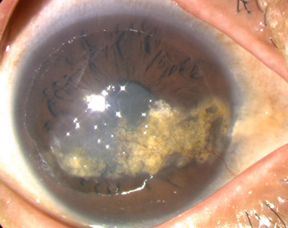 図は膠様滴状角膜ジストロフィー患者の前眼部の写真